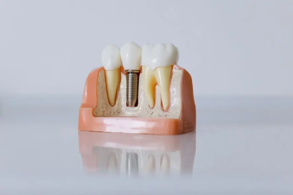 Implantes Dentales en Diagonal Mar | Planificación 3D y Seguimiento